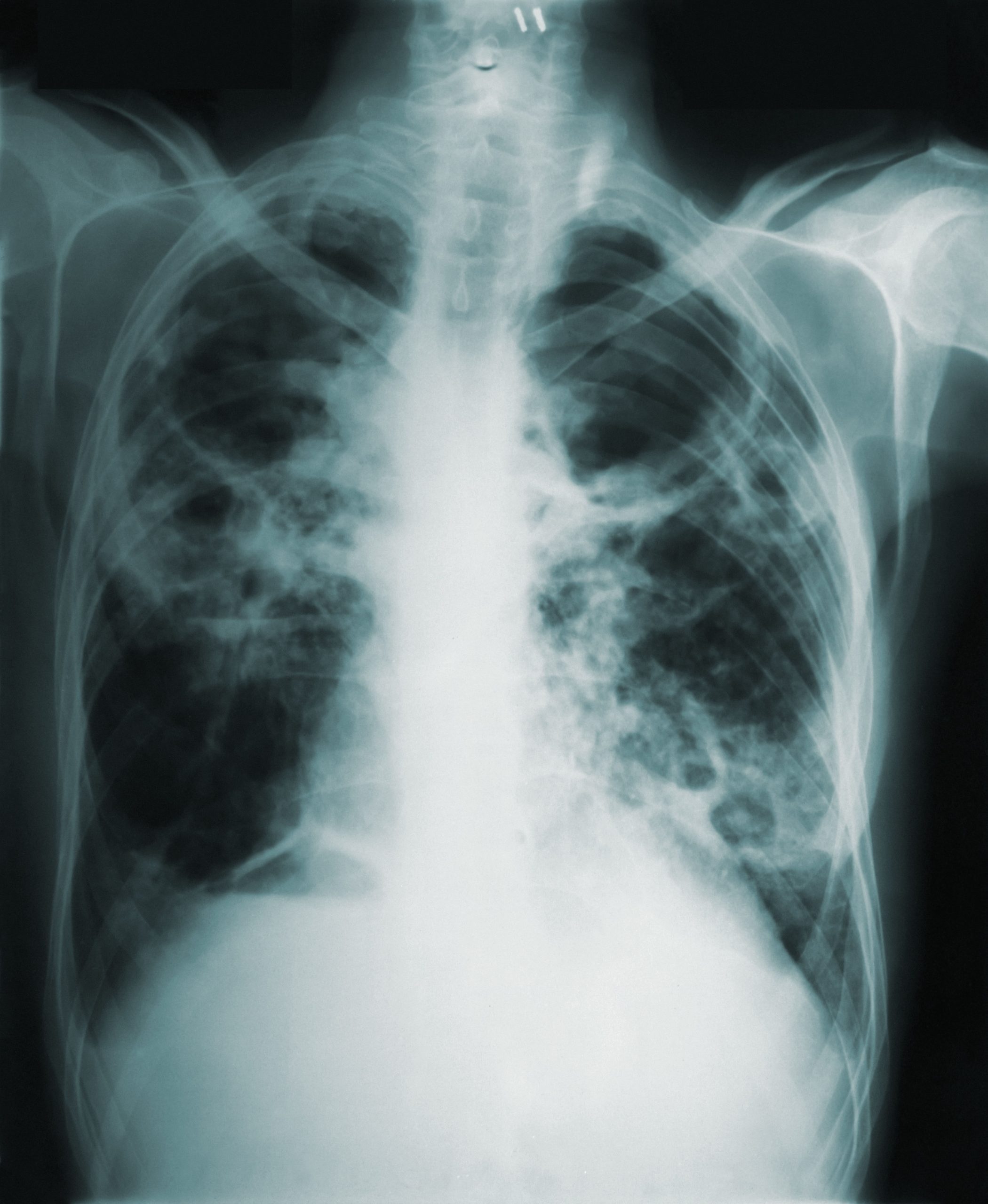 Pulmonary tuberculosis